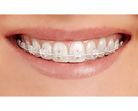 Cosmetic Braces
